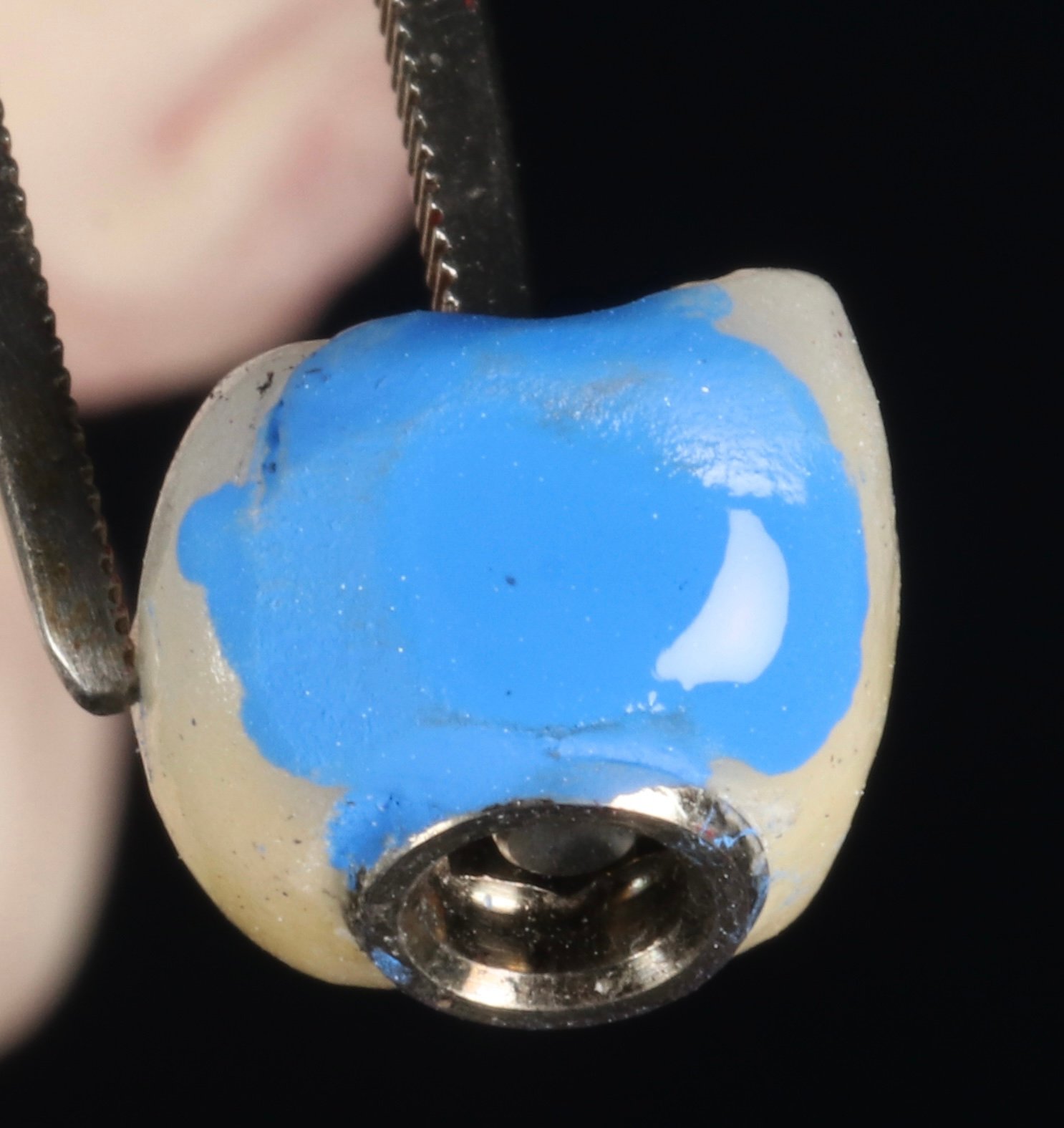 Planificación digital de implantes